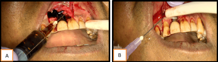 a,b: Irrigation with povidine iodine and normal saline