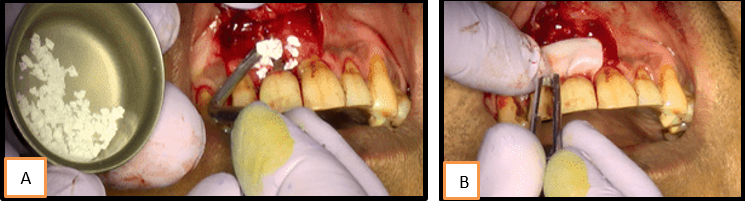 a,b: Graft and membrane placement