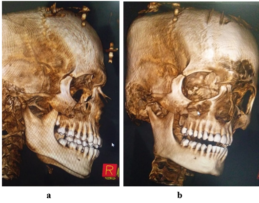 (a) - Pre-op CT scan - Lateral view (b) - Pre- op CT Scan – Frontal view