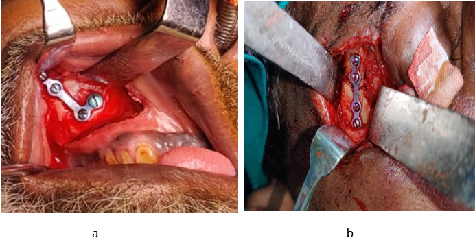 (a) intra-op- buttress plating (b) intra op zygomaticomaxillary plating