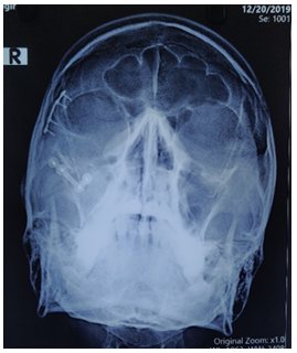 Post-op para-nasal sinus view radiograph