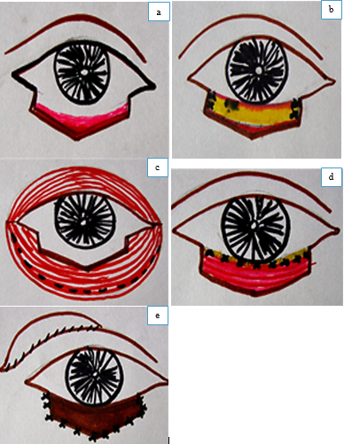a: Tumour excised and conjunctiva in lower fornix mobilized; b: A free graft of donor sclera sutured to the two ends of remaining tarsus; c: A bi-pedicle flap from orbital part of Orbicularis muscle split and mobilized; d: Mobilised orbicularis bi-pedicle flap sutured to the upper border of conjunctiva and the scleral graft; e: Free skin graft from opposite lid or retro-auricular area sutured to the margins of the defect. 