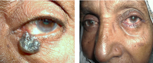 A BCC extending to medialcanthus, excised and reconstructed (pre and post-operative photos).