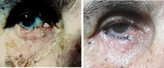 A squamous cell carcinoma excised and lid reconstructed.