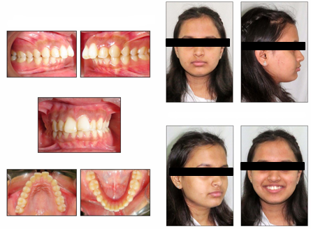 Pretreatment intraoral and extraoral records
