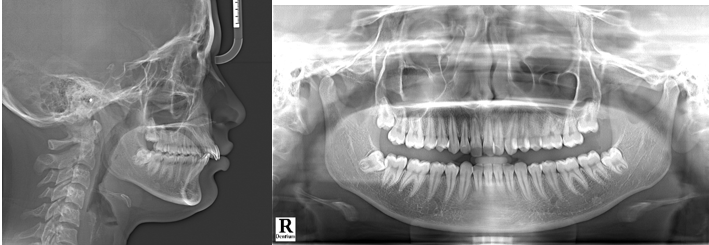 Pre treatment lateral cephalogram and orthopantomogram