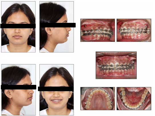 Treatment mechanics and mid-treatment intraoral and extraoral records