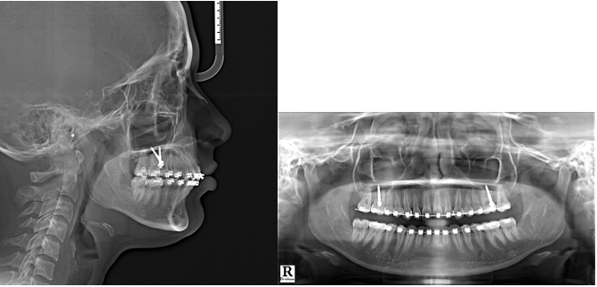 Mid treatment lateral cephalogram and orthopantomogram
