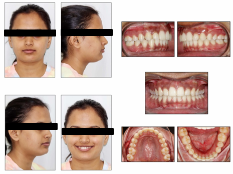 Post distalisation intraoral and extraoral records