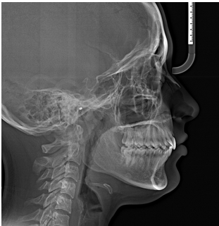 Post treatment lateral cephalogram