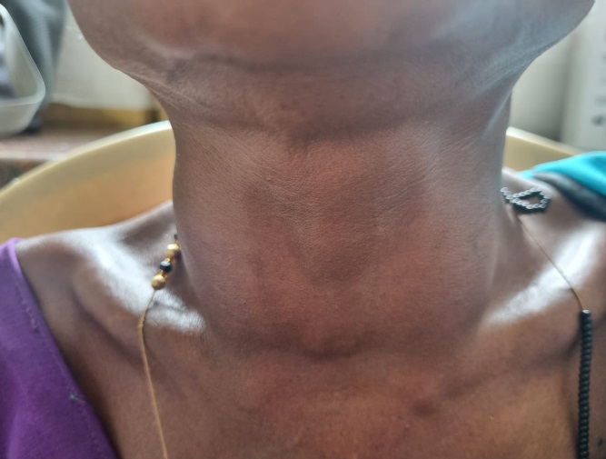 Diffuse Thyroid swelling in neck.