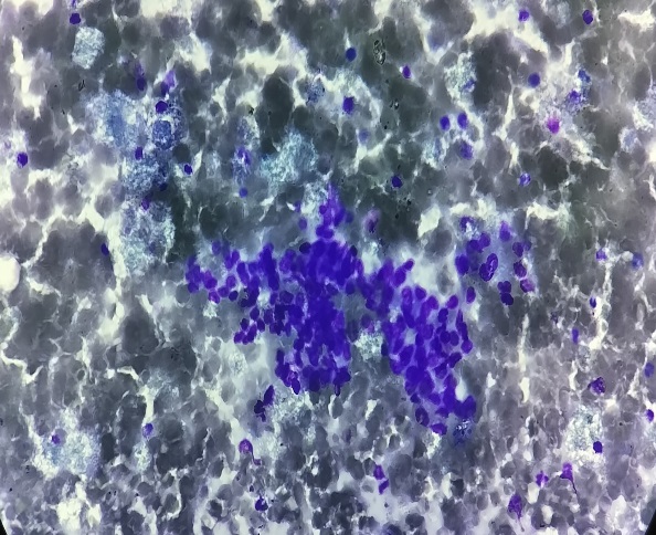 FNAC– showing large polygonal cells with pleomorphic features.