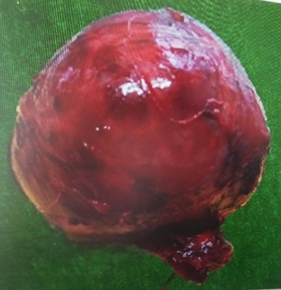 Total thyroidectomy specimen. Right lobe, measuring 8x7x4 cm. dark brown smooth glistening. Left lobe 4x2x1cm.