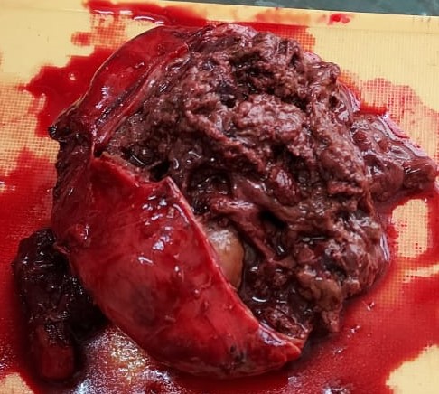 Cut section–shows multiple friable brown tissue bits and drained 20-30ml of colloid.