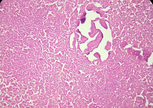 20x H and E stain –Showing tumor cells arranged in micro and macrofollicular pattern and focal papillary pattern.