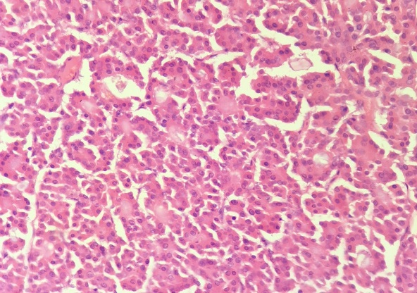 40x H and E stain - Showing oncocytic cells with abundant granular eosinophilic cytoplasm.