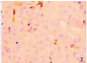 IHC for Galectin -3 negetive.