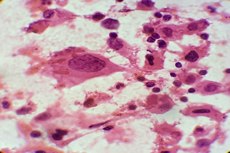 Metastatic squamous cell carcinoma showing scattered malignant squamous cells exhibiting cytoplasmic keratinization. H and E x 1000