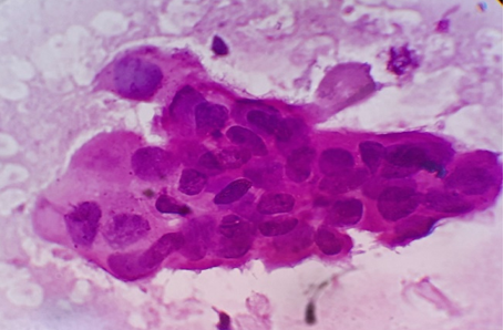 Metastatic adenocarcinoma showing cluster of malignant epithelial cells exhibiting glandular differentiation. H and E x 1000