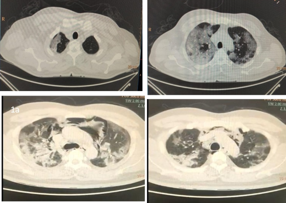 NCCT CIIEST: a & b: Peripheral pleural based ground glass opacities (GGO) involving right upper lobe la and bilateral lower lobes lb. c: Confluent area of consolidation with bilateral ground glass opacities having a peripheral posterior predominance seen involving both upper lobes. Foci of free air arc seen surrounding the mediastinal vessels and trachea s/o pncumomcdiastinum; d: Similar confluent areas of consolidation with more pronounced bilateral sub-pleural rounded ground glass opacification and inter-lobular septal thickening. Pneumomediastinum is seen.