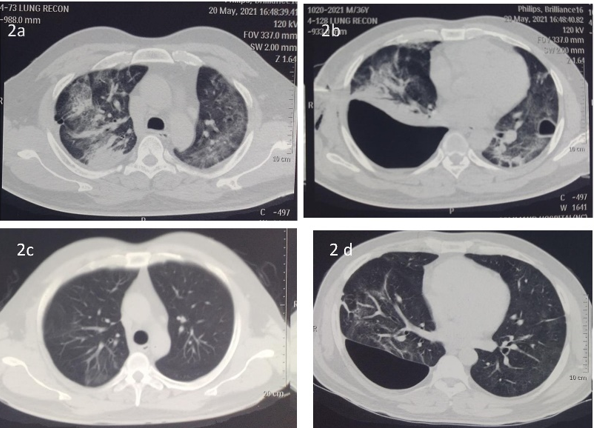 NCCT (CHEST); a: Ground glass haziness (GGO's) bilateral lung fields; b: Pneumatocele left lower lobe and hydropneumothorax right; c: Resolution of GGO as compared; a,d: Complete resolution of pneumatocele with partial resolution of right sided loculated hydropneumothorax.