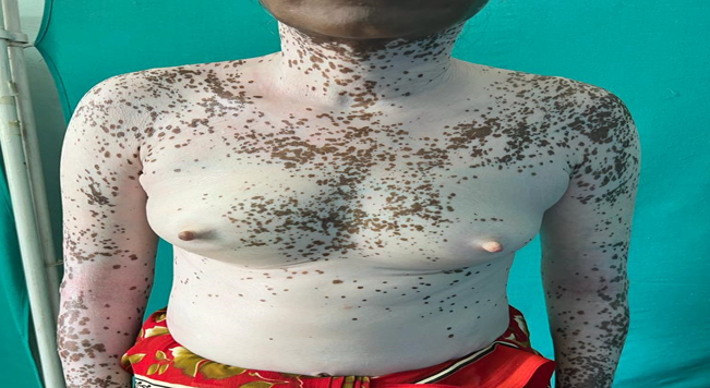 Generalized vitiligo