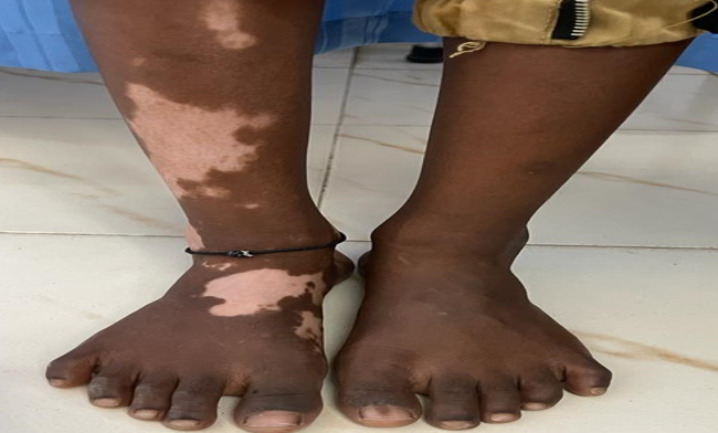 Segmental vitiligo