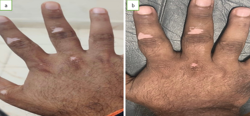 a,b: Before NV-UVB and After 8 sessions of NB-UVB showing change in colour to erythematous and decrease in few small patches