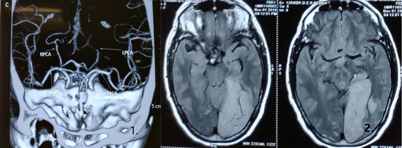 Patient A - 1. Left PCA P2 segment attenuation 2. Left PCA infarct 