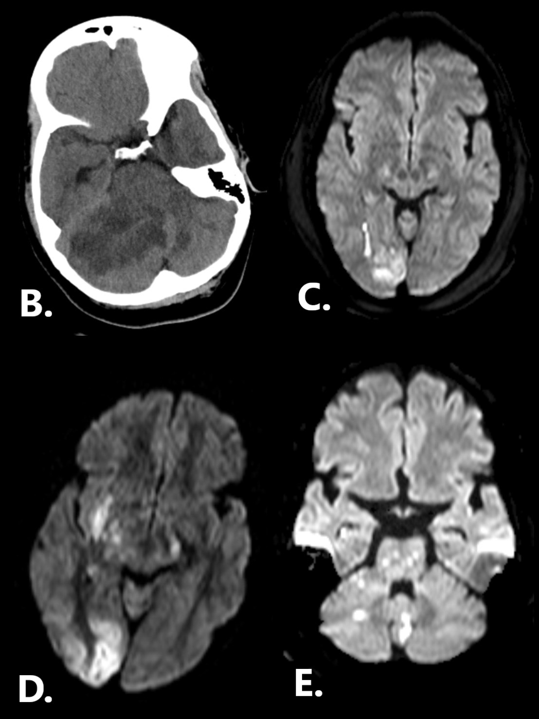 B - (Patient B) Right cerebellar infarct with mass effect on fourth ventricle and brainstem, C - (Patient C) Right PCA territory Acute Infarct, D – (Patient D) Right PCA and Right Gangliocapsular acute infarct, E- (Patient E) Multiple Brainstem and cerebellar infarcts