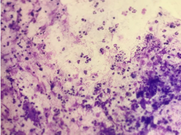 (Giemsa, 200X) neutrophilic cellular pattern in suspected case of Non-specific Interstitial Pneumonia.