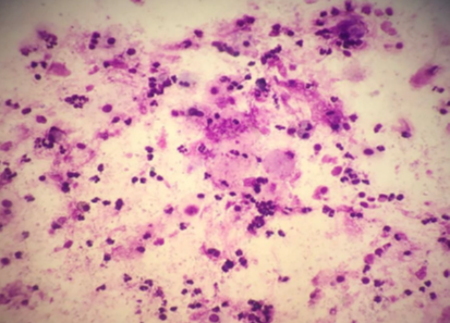 (Giemsa, 200X) Neutrophilic cellular pattern in suspected case of Cryptogenic organizing pneumonia (COP).