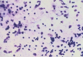 (Giemsa, 400X) Increased Lymphocytes count along with alveolar macrophages in suspected case of Sarcoidosis