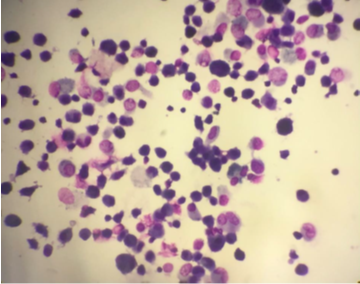 (Giemsa, 400X) Increased Lymphocytes count along with alveolar Macrophages in suspected case of UIP