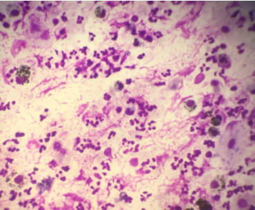 (Giemsa, 400X) Neutrophilic Cellular Pattern in suspected case of Hypersensitivity Pneumonitis