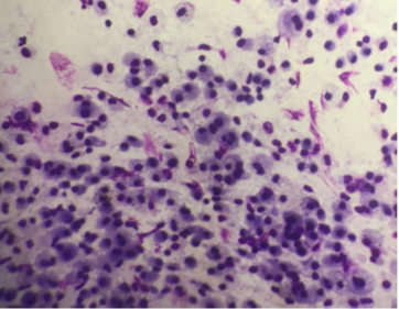 (Giemsa, 400X) Normal cellular pattern in suspected case of Non-specific Interstitial Pneumonia.