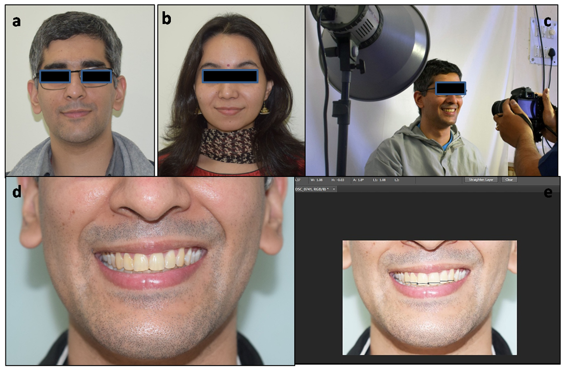 Prevalence Of Dental Esthetic Proportions And Its Correlation With 
