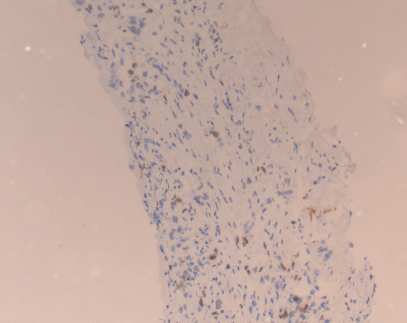 Nuclear immunohistochemical staining for Ki 67 in invasive breast carcinoma. Ki 67 staining is 10%