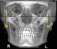Skull frontal view showing the lines IM and LM; and the points C and O