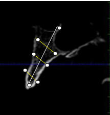 Thickness of zygoma (yellow lines) and length of zygoma (white line)