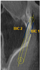 The length of BIC on facial aspect (BIC1) and on temporal (BIC2) sides (blue lines)