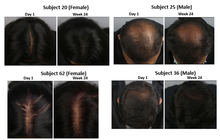 Representative photographs of Female and Male subjects showing improved coverage.