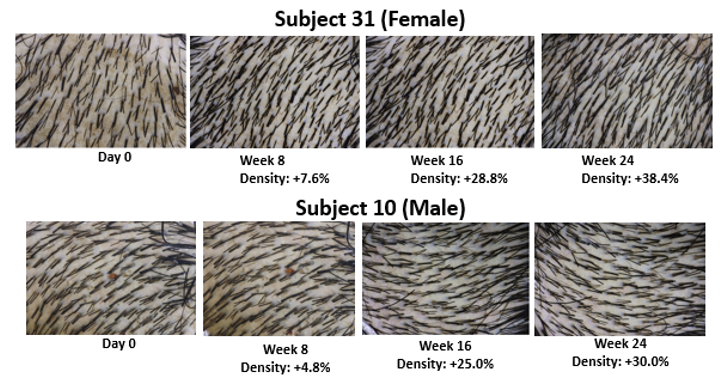 Representative hair density changes during the course of the clinical trial 