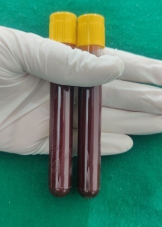 Whole blood collected in 2 ACDA (Acid Citrate Dextrose-A) vacutainer