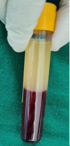 After 1st spin, supernatant plasma, buffy coat and RBC layer are formed