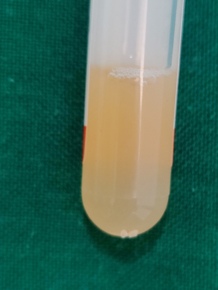 Upper 3/4th PPP is discarded, and lower 1/4th PRP containing platelet pellet and RBC at the bottom is resuspended to form homogenized PRP