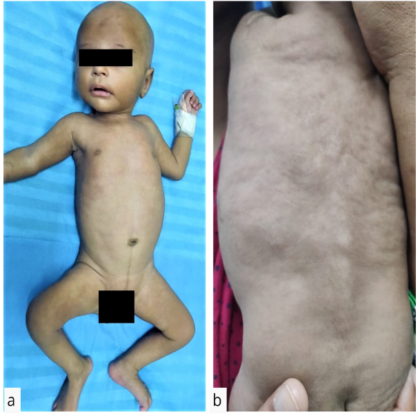 Multiple skin coloured, palpable nodules and plaques present on the arms, back, legs and cheeks (a) anterior surface (b) posterior surface