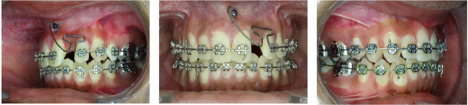 T loop mechanics