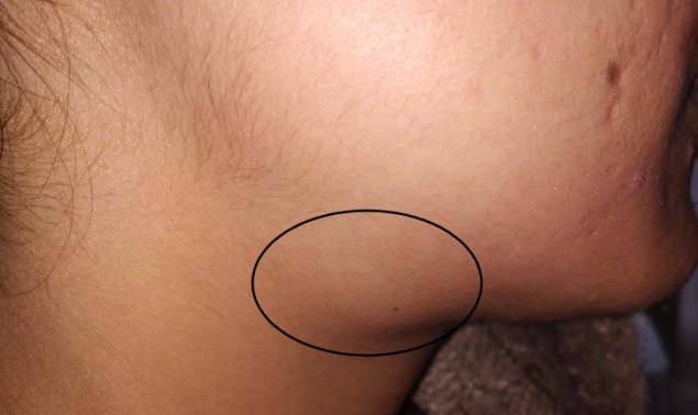 Showing Submandibular Swelling on right side