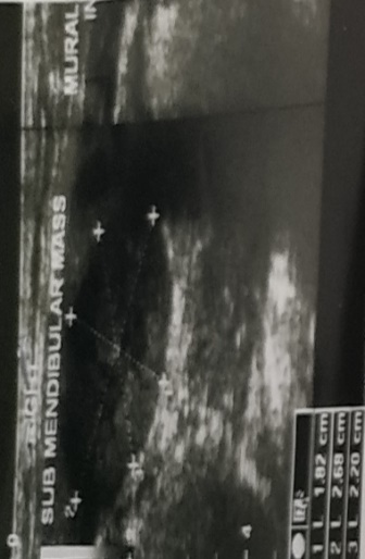 USG image showing submandibular region mass